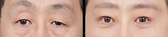 眼部 Before & After — Restory 整形外科