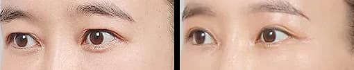 眼部 Before & After — Restory 整形外科