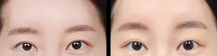 眼部 Before & After — Restory 整形外科