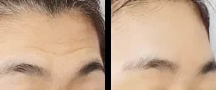 轮廓 Before & After — Restory 整形外科
