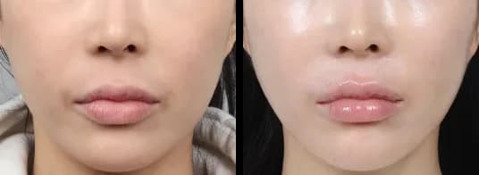 轮廓 Before & After — Restory 整形外科