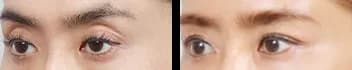 眼部 Before & After — Restory 整形外科