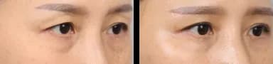 眼部 Before & After — Restory 整形外科