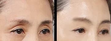 轮廓 Before & After — Restory 整形外科