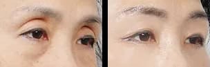 眼部 Before & After — Restory 整形外科