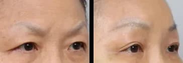 轮廓 Before & After — Restory 整形外科