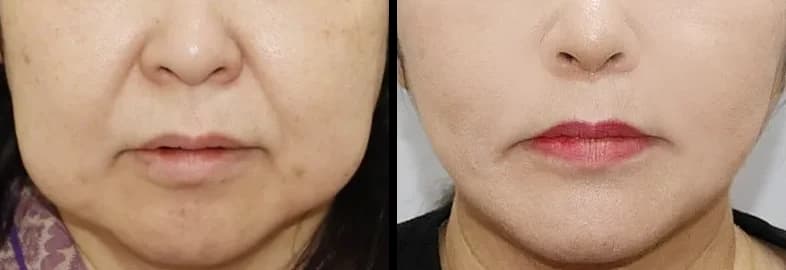 下颌线·嘴唇·牙科 Before & After — Restory 整形外科