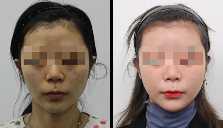 皮肤管理 Before & After — Restory 整形外科