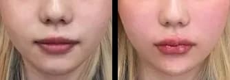 皮肤管理 Before & After — Restory 整形外科