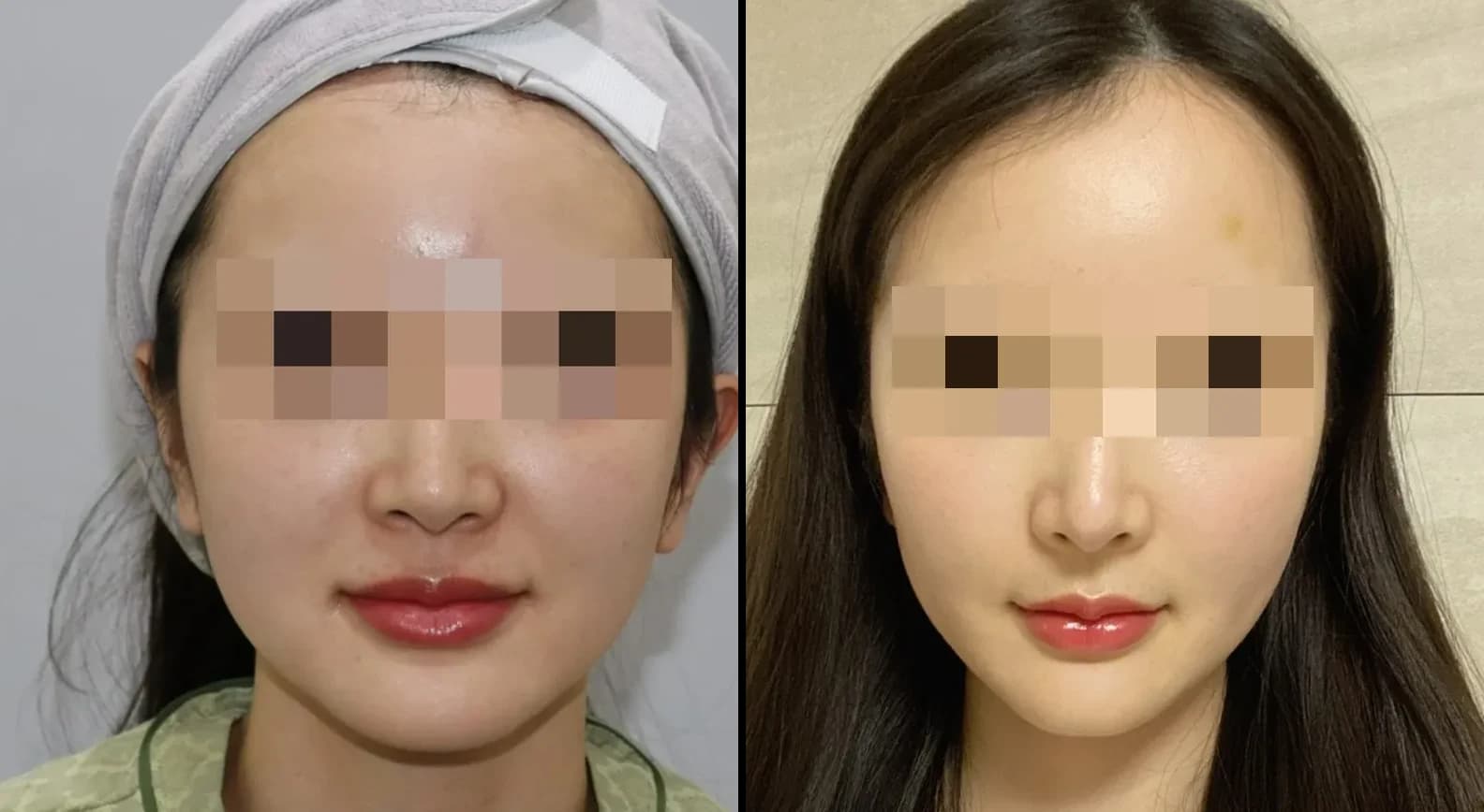 皮肤管理 Before & After — Restory 整形外科