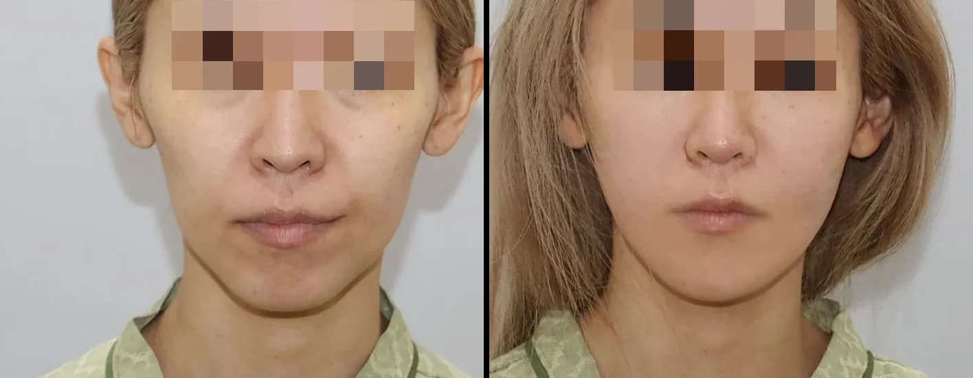 皮肤管理 Before & After — Restory 整形外科