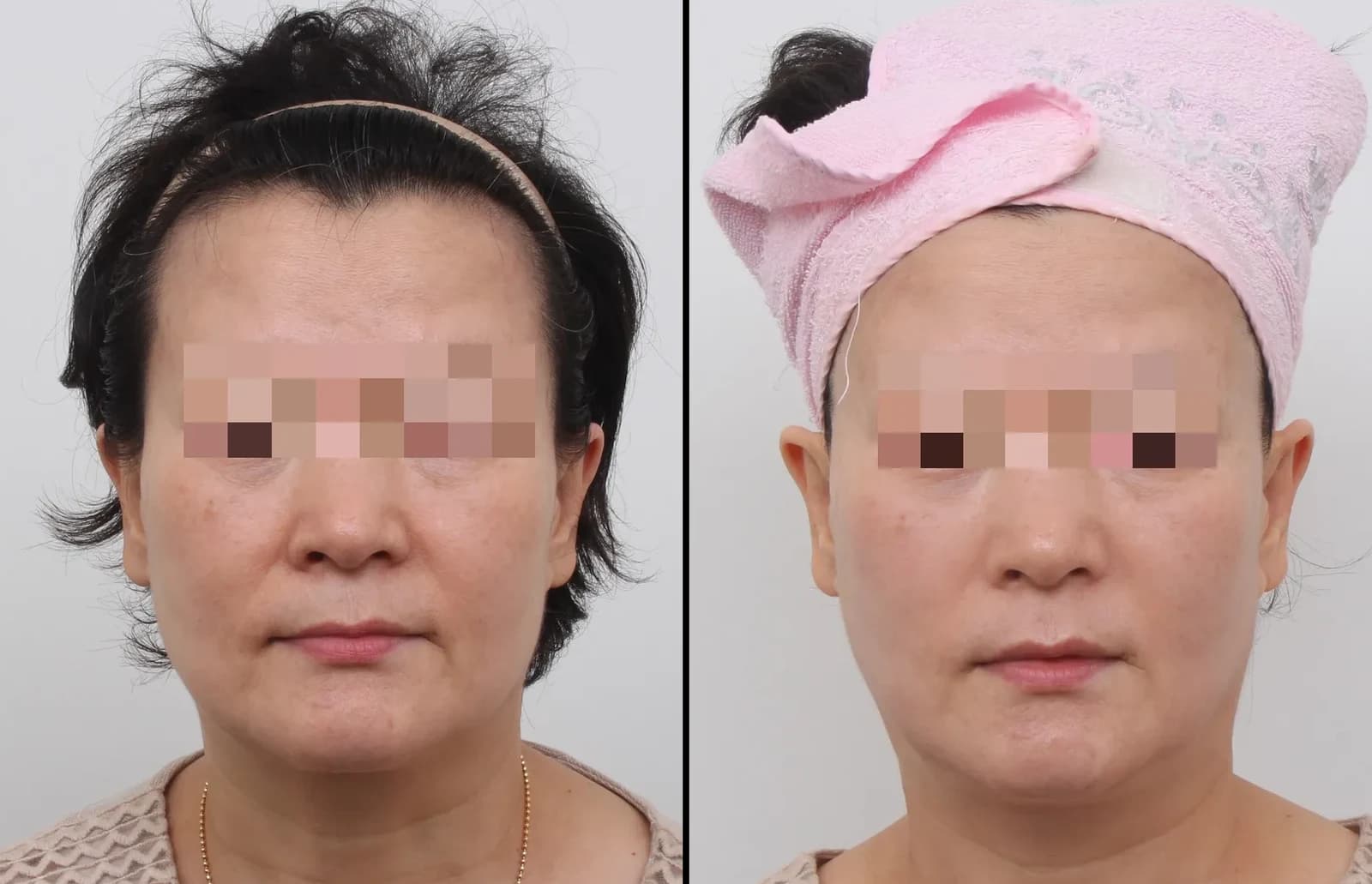 皮肤管理 Before & After — Restory 整形外科