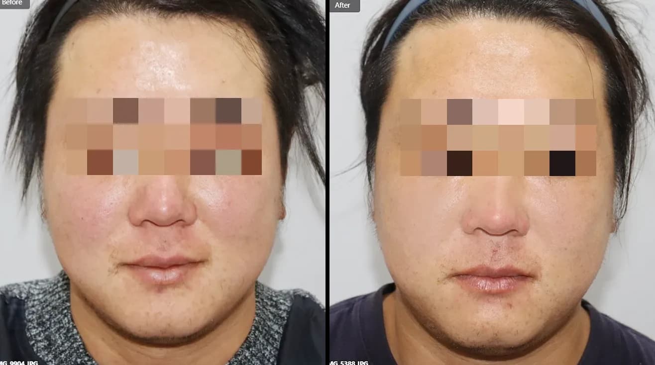 皮肤管理 Before & After — Restory 整形外科