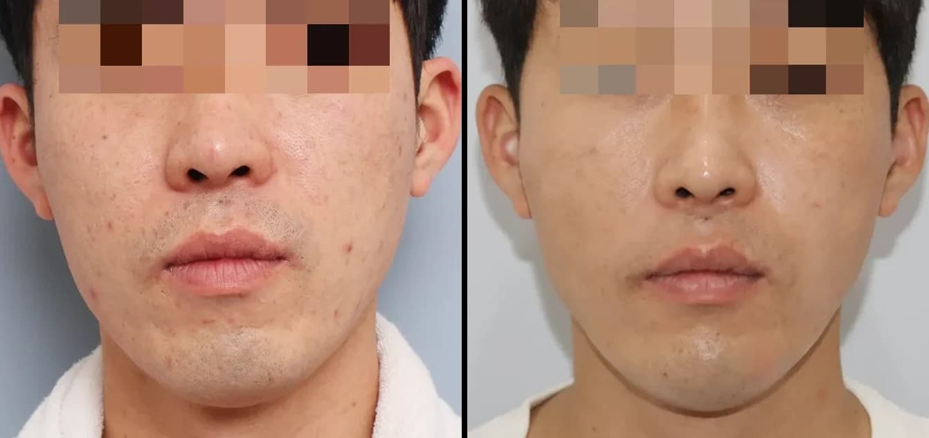皮肤管理 Before & After — Restory 整形外科