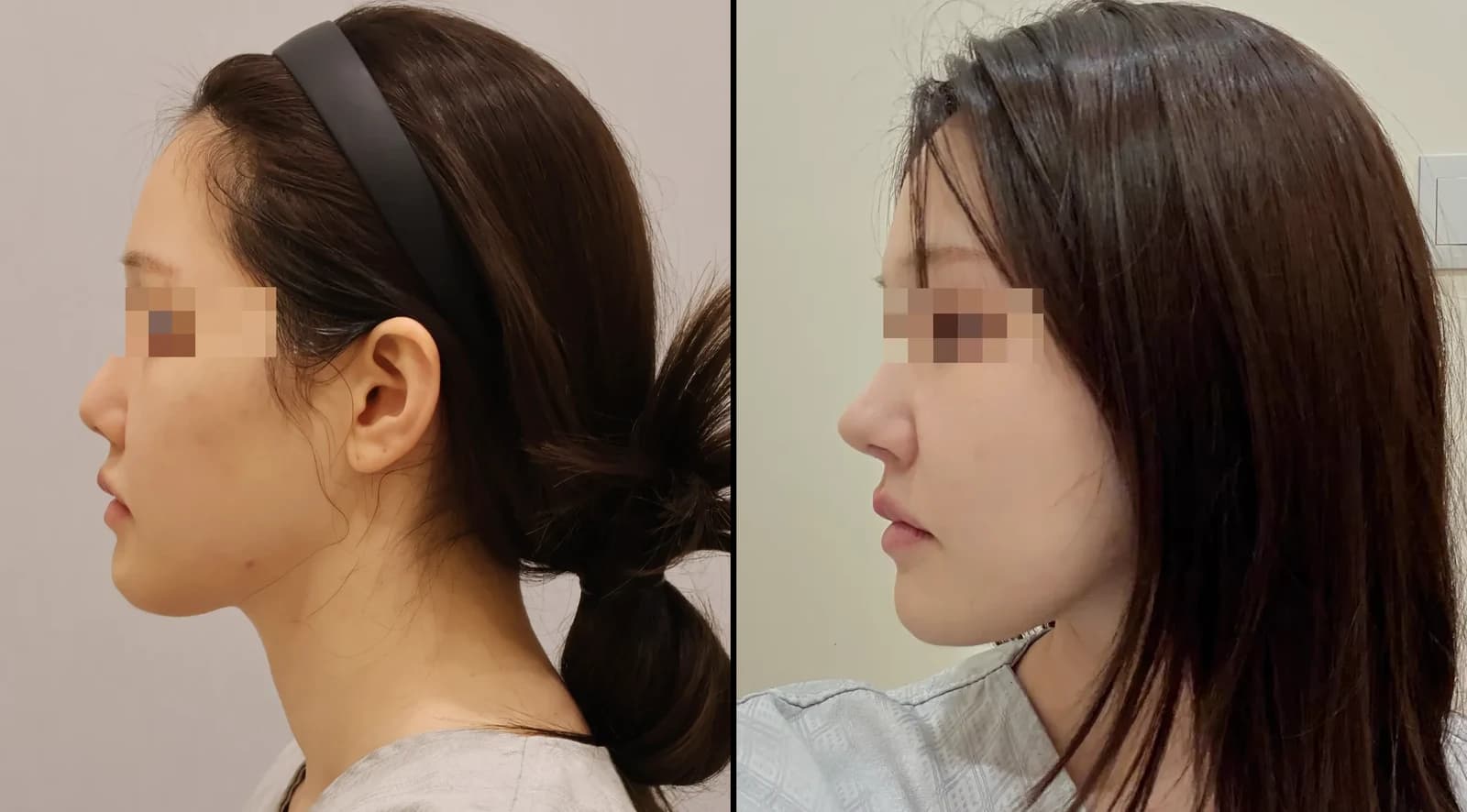 鼻部 Before & After — Restory 整形外科