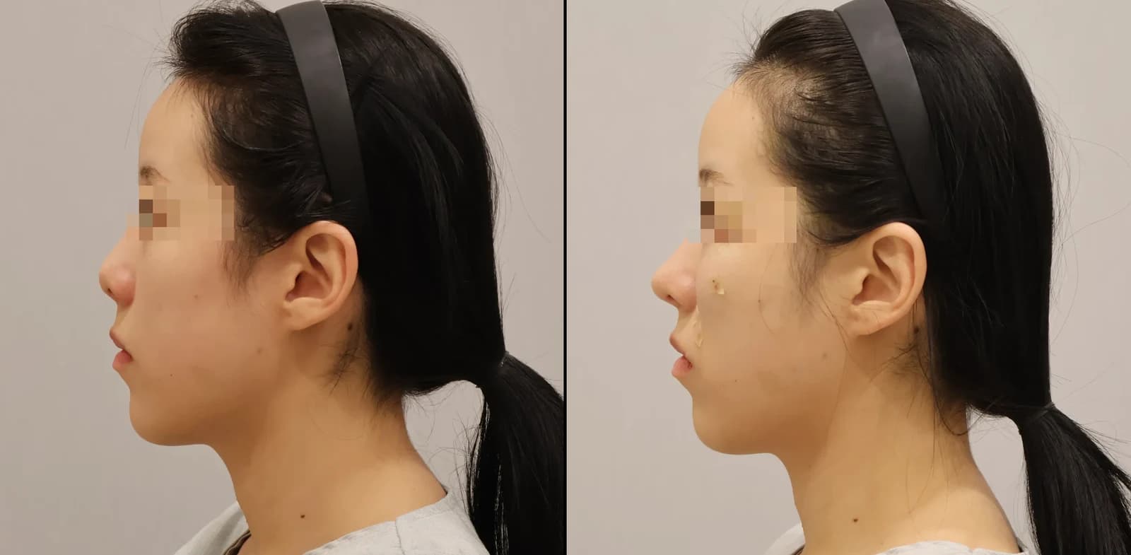 鼻部 Before & After — Restory 整形外科