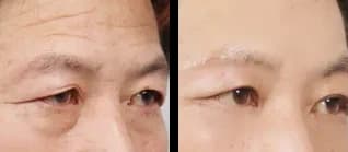 轮廓 Before & After — Restory 整形外科